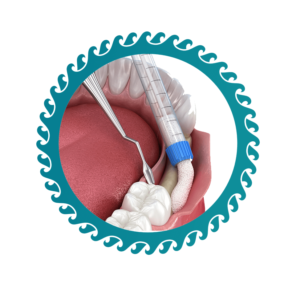 close up of 3d illustrated bine grafting procedure