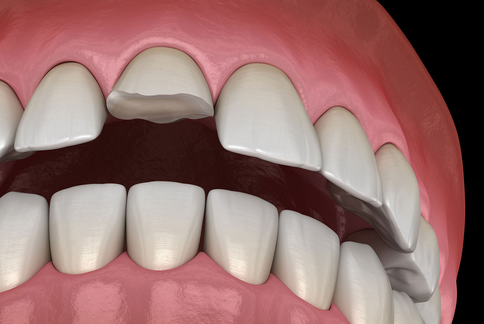 Broken central incisor tooth. Medically accurate 3D illustration of human teeth