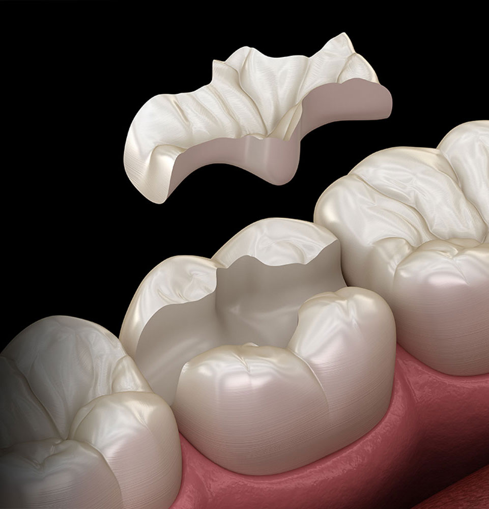 3d illustrated of inlays dental implants