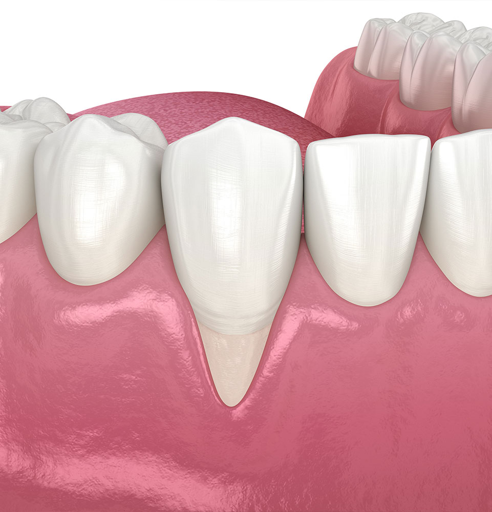 illustration of gum recession