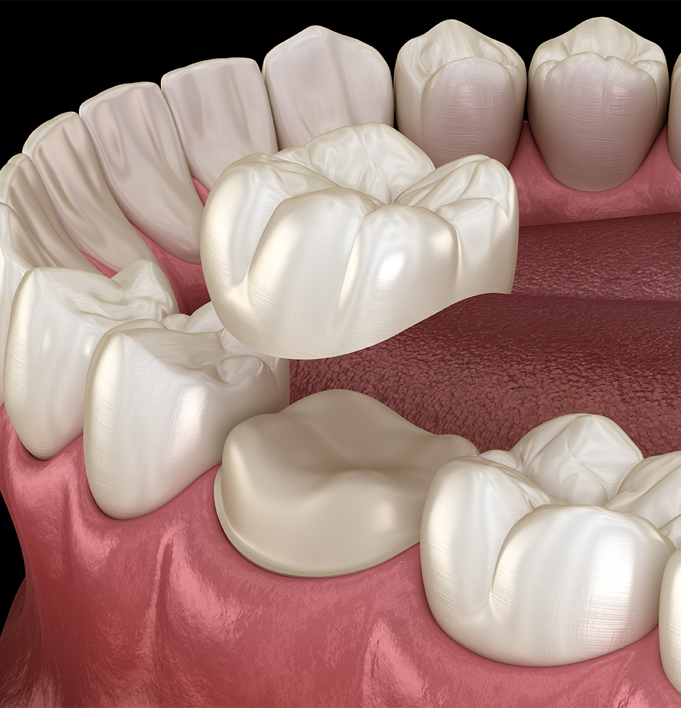 Preparated molar tooth for dental crown placement. Medically accurate 3D illustration By Alex Mit