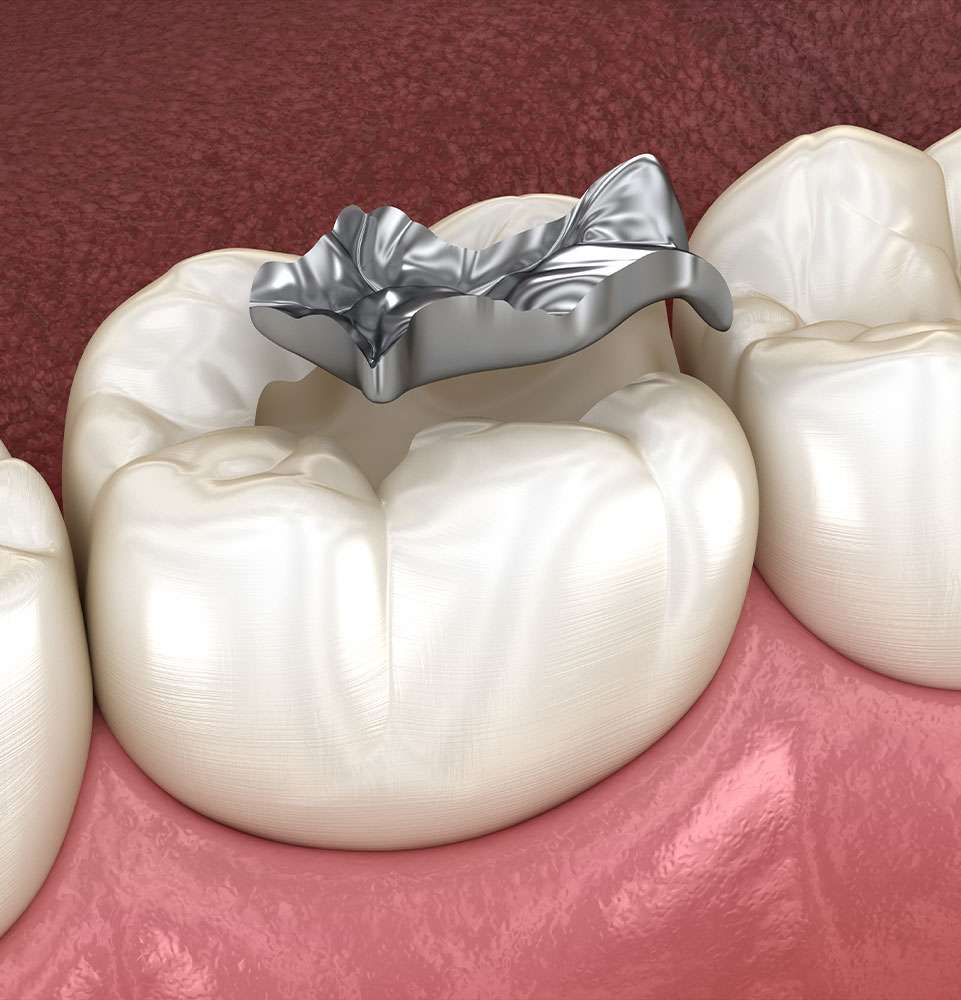 Inlay silver crown fixation over tooth. Medically accurate 3D illustration of human teeth treatment