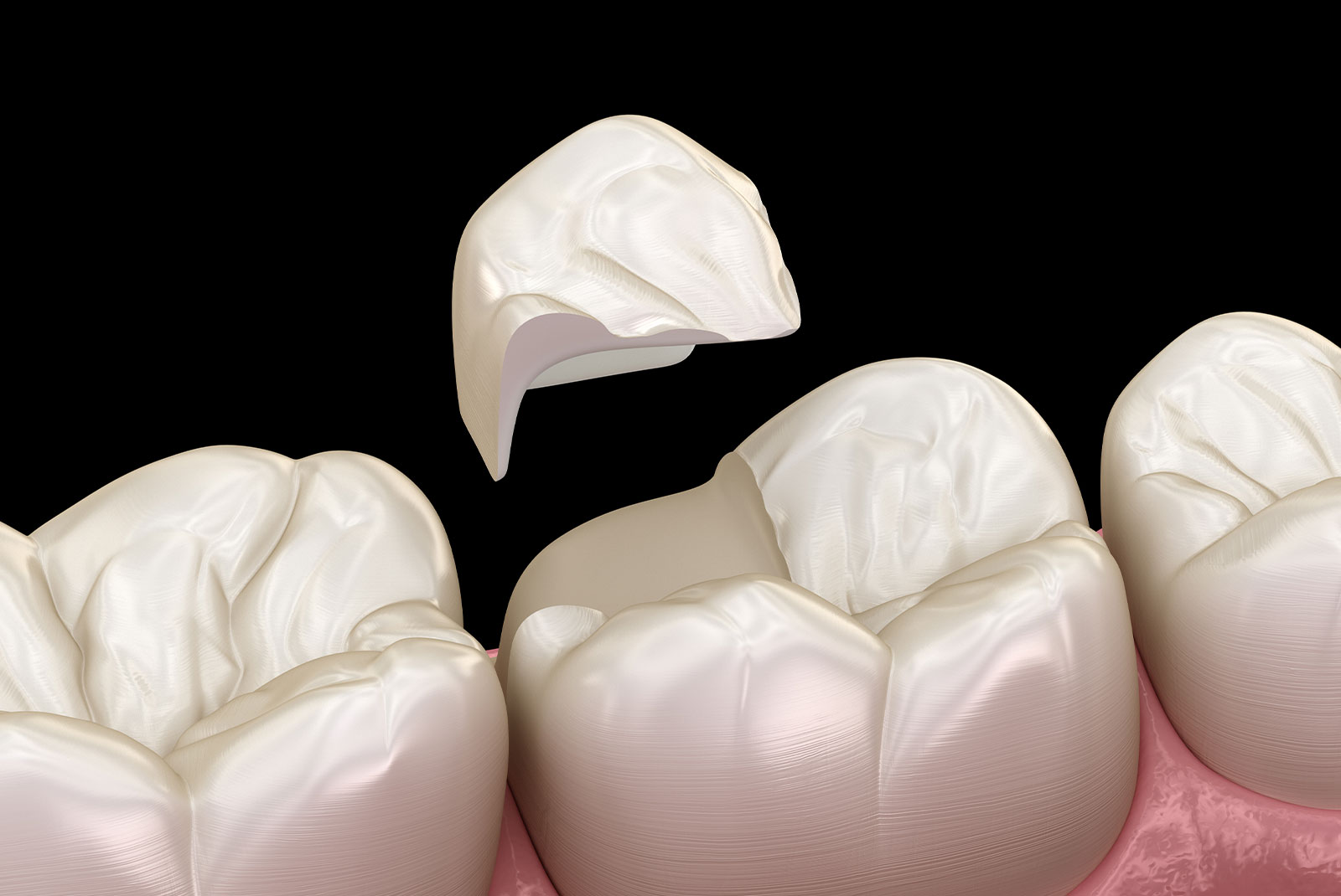 Onlay ceramic crown fixation over tooth. Medically accurate 3D illustration of human teeth treatment