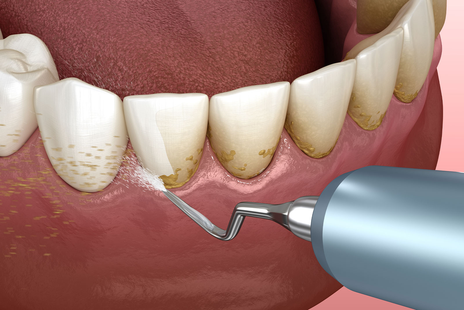 Scaling and root planing (conventional periodontal therapy). Medically accurate 3D illustration of human teeth treatment