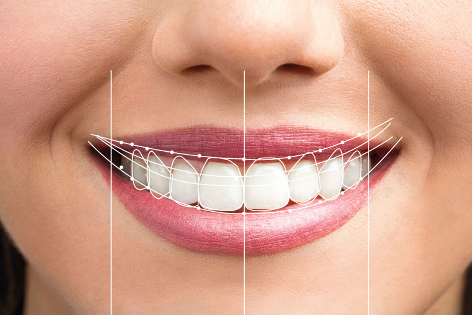 smile design preview