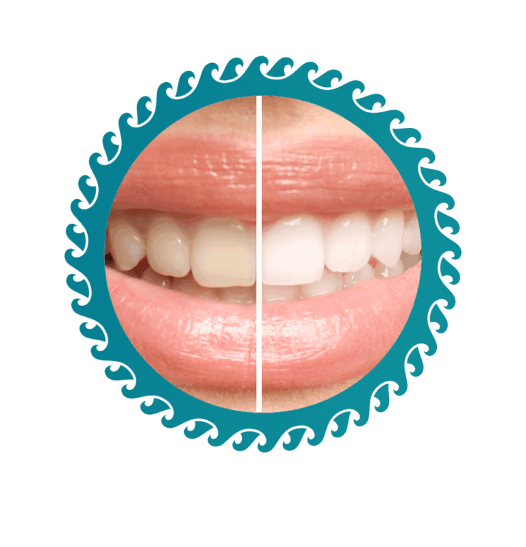 Professional Teeth Whitening Brandon FL | Brandon Complete