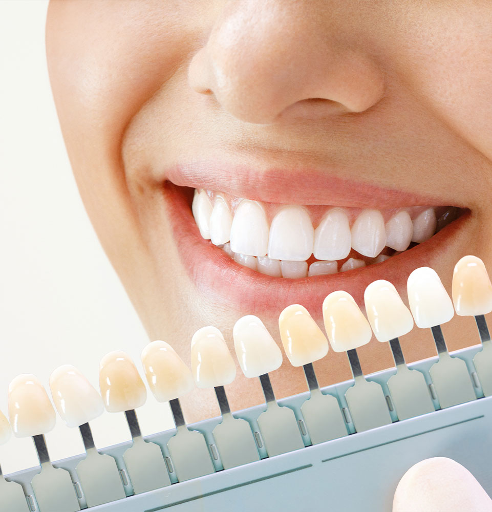 close up of teeth whitening patient